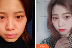 上海微藍醫(yī)療美容門診部陳意文整形價格表附埋線提升案例展示