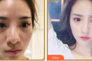 上海微藍醫(yī)療美容門診部鄭珉在整形價格表附鼻部多項案例展示