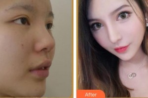 上海微藍醫(yī)療美容門診部鐘國平整形價格表附鼻部綜合案例展示