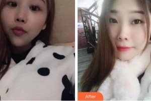 上海安平醫(yī)院美容科肖建山整形價格表附自鎖托槽矯正案例展示