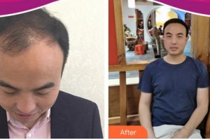 上海名格醫(yī)療美容門診部張敏整形價格表附植發(fā)養(yǎng)發(fā)案例展示