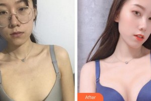 上海賽美瑞醫(yī)療美容門診部張化舉整形價格表附濃縮豐胸真實案例展示