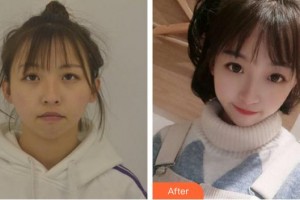 上海柏薈醫(yī)療美容門診部黃耀麟整形價(jià)格表附下頜角+皮質(zhì)骨+夾脂墊案例展示