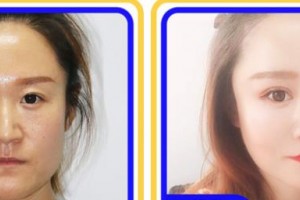 上海希瑪瑞視眼科醫(yī)院張偉英整形價(jià)格表附眼部綜合案例展示