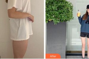 成都市第三人民醫(yī)院醫(yī)學(xué)整形美容科葉飛輪整形價(jià)格表附大腿吸脂案例展示