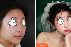 成都市第三人民醫(yī)院醫(yī)學(xué)整形美容科段冬梅整形價(jià)格表附紅寶石激光祛斑案例展示