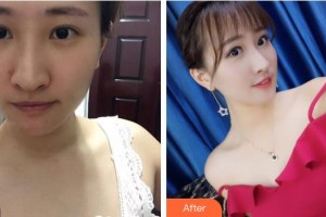 成都儀美醫(yī)療美容門診部周儀整形價(jià)格表附鼻部手術(shù)案例展示