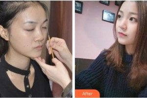 成都米蘭柏羽醫(yī)學(xué)美容醫(yī)院唐林俊整形價(jià)格表附假體隆鼻+鼻頭塑形案例展示