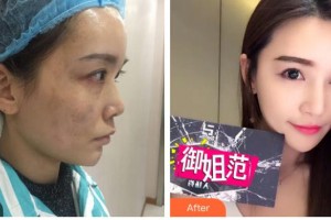 成都米蘭柏羽醫(yī)學(xué)美容醫(yī)院王煬整形價(jià)格表附激光美膚祛斑案例展示