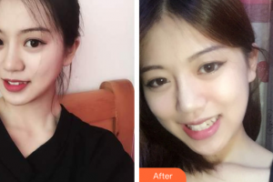 廣州星團(tuán)醫(yī)學(xué)美容門診部邱煥標(biāo)整形價(jià)格表附面部輪廓案例展示