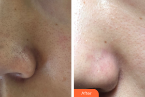 廣州曙光醫(yī)學(xué)美容醫(yī)院鐘金源整形價(jià)格表附水氧活膚案例展示