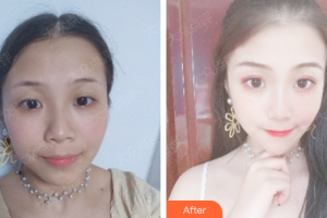 廣州華美醫(yī)療美容醫(yī)院王洪勇整形價(jià)格表附無(wú)針?biāo)獍咐故?>
</a>
<h3 class=