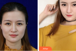 廣州曙光醫(yī)學(xué)美容醫(yī)院王娟整形價格表附面部吸脂案例展示