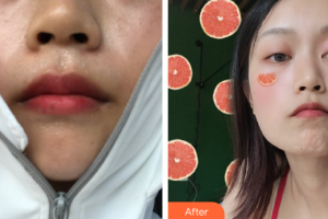 廣州華美醫(yī)療美容醫(yī)院朱葛勇整形價(jià)格表附光子嫩膚案例展示