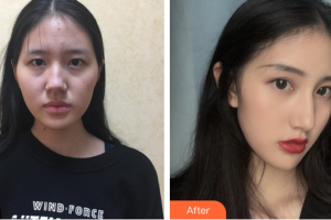 廣州博研醫(yī)療美容門診部陳伯華整形價(jià)格表附隆鼻案例展示