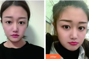 廣州市白云區(qū)第一人民醫(yī)院燒傷整形科董玉明 整形價(jià)格表附埋線雙眼皮案例展示