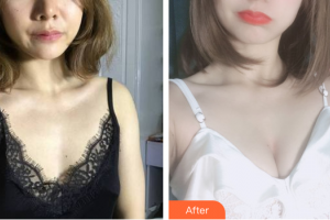 廣州市紅十字會(huì)醫(yī)院燒傷整形科童仁聯(lián)整形價(jià)格表附自體脂肪隆胸案例展示