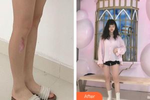 廣州市紅十字會醫(yī)院燒傷整形科梁岷整形價格表附增生疤痕案例展示