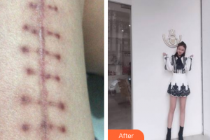 廣州市紅十字會醫(yī)院燒傷整形科李葉揚整形價格表附微創(chuàng)疤痕修復案例展示