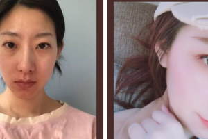 南京素麗醫(yī)療美容診所邢麗君整形價格表附肋軟骨隆鼻案例展示