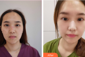 廣州中家醫(yī)家庭醫(yī)生醫(yī)學整形美容醫(yī)院申汶錫整形價格表附激光祛痣點痣案例展示