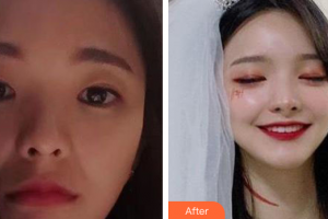 廣州南珠醫(yī)療美容門診部張瑤整形價格表附嫩膚美白案例展示