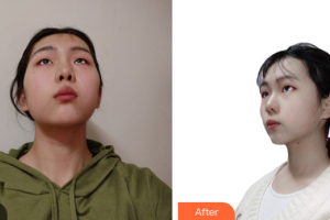 廣州博仕整形美容醫(yī)院青莉整形價格表附光子嫩膚案例展示