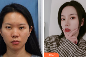 廣州南珠醫(yī)療美容門診部黃文博整形價格表附鼻部整形案例展示