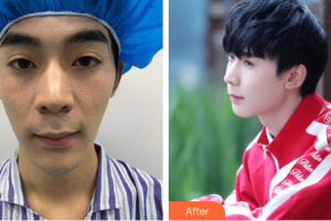 廣州博仕整形美容醫(yī)院朱曉春整形價格表附鼻部手術案例展示