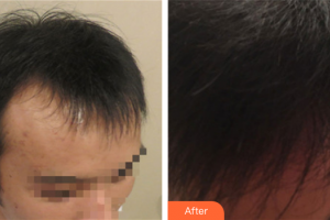 廣州新發(fā)現(xiàn)植發(fā)連鎖機構吳安利整形價格表附種植發(fā)際線案例展示