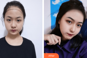 廣州新發(fā)現(xiàn)植發(fā)連鎖機構魯聰聰整形價格表附發(fā)際線種植案例展示