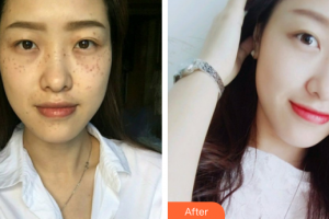 廣州華美醫(yī)療美容醫(yī)院賴紅梅整形價格表附超激光美膚祛斑案例展示