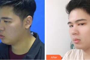 廣州韓妃醫(yī)學美容醫(yī)院金炫秀整形價格表附縮脂針案例展示