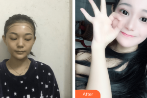 廣州新發(fā)現(xiàn)植發(fā)連鎖機構宋振寧整形價格表附種植發(fā)際線案例展示