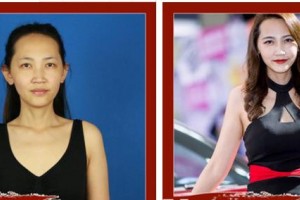 成都米蘭柏羽醫(yī)學(xué)美容醫(yī)院宋淑萍整形價(jià)格表附假體隆胸案例展示