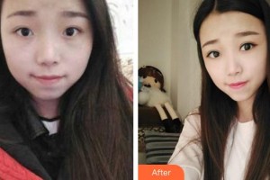 成都百齡駐顏醫(yī)學(xué)美容門診部劉寧整形價(jià)格表附眼部手術(shù)案例展示