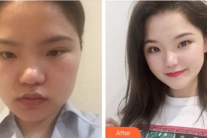 成都艾尚醫(yī)學(xué)美容門診部王濤整形價(jià)格表附發(fā)際線種植案例展示