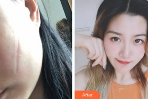 成都美立方（原華博）醫(yī)療美容醫(yī)院姚波整形價格表附手術(shù)祛疤案例展示