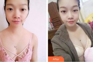 成都美容整形醫(yī)院劉來新整形價格表附濃縮豐胸真實(shí)案例展示