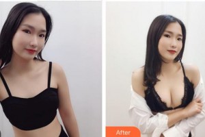 成都華顏醫(yī)療美容門診部王平整形價格表附濃縮豐胸真實(shí)案例展示