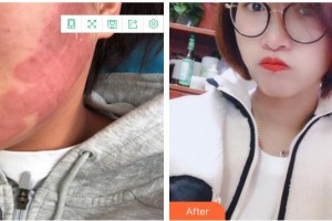 成都美極醫(yī)療美容門診部黃華整形價格表附點(diǎn)陣祛痘坑痘印案例展示