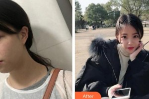 成都美立方（原華博）醫(yī)療美容醫(yī)院費(fèi)曉紅整形價格表附超激光美膚激光案例展示