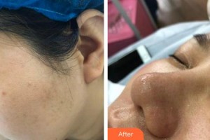 成都悅好醫(yī)學(xué)美容醫(yī)院王丹整形價格表附小蔡果酸案例展示