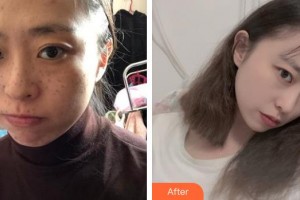 成都蜀尚蓉雅美容整形醫(yī)院陳秀榮整形價格表附鼻部手術(shù)案例展示