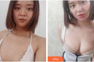 成都金榮醫(yī)學(xué)美容診所周金芳整形價格表附濃縮豐胸真實(shí)案例展示