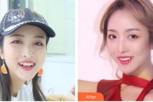 成都美容整形醫(yī)院鄺倫整形價格表附隱形托槽矯正案例展示