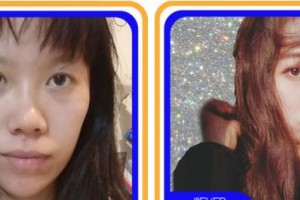 成都金榮醫(yī)學美容診所葛冬梅整形價格表附鼻部手術(shù)脂肪填充案例展示