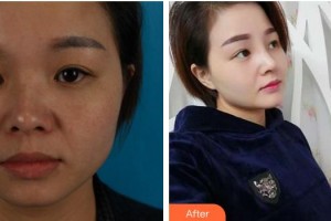 成都金榮醫(yī)學(xué)美容診所林登文整形價格表附隆鼻案例展示