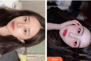 成都金榮醫(yī)學美容診所張高欣整形價格表附小氣泡案例展示