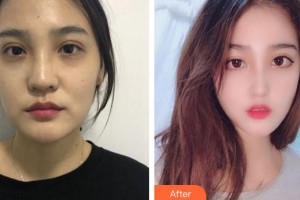 成都美瑞皮膚美容門診部邵勇整形價格表附隆鼻案例展示